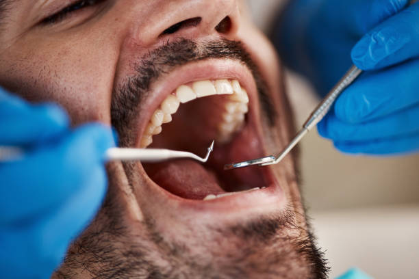 Best Emergency Dentist for Knocked-Out Tooth in Cashion, OK