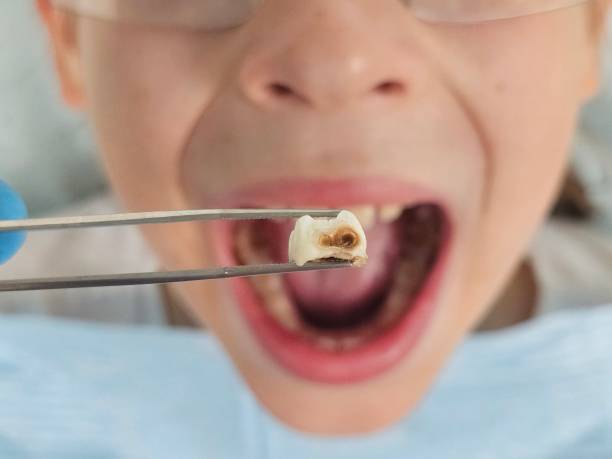 Best Emergency Root Canal Treatment in Cashion, OK
